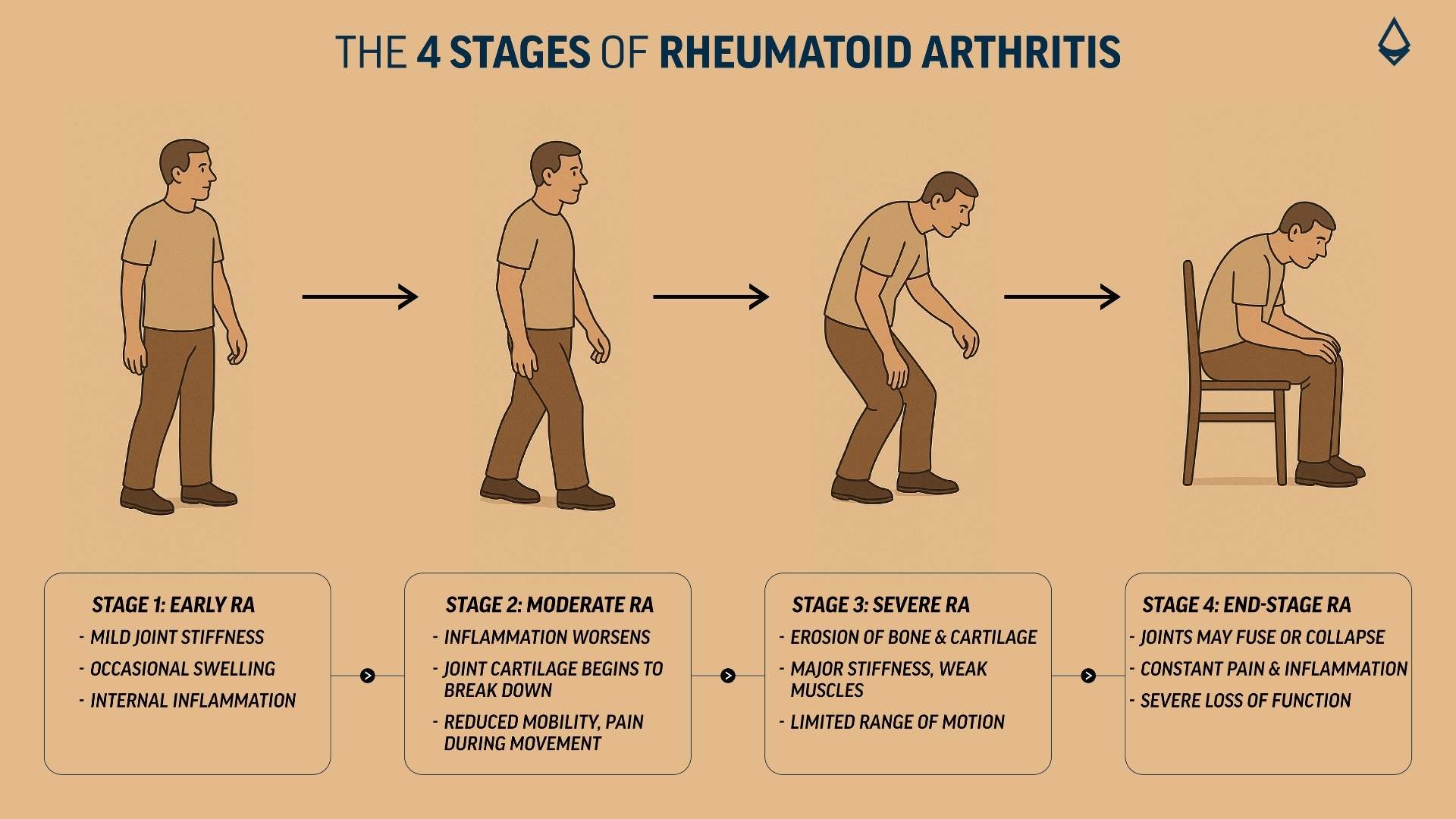 An infographic showing the four stages of rheumatoid arthritis, from stage 1 to stage 4 along with the key symptoms
