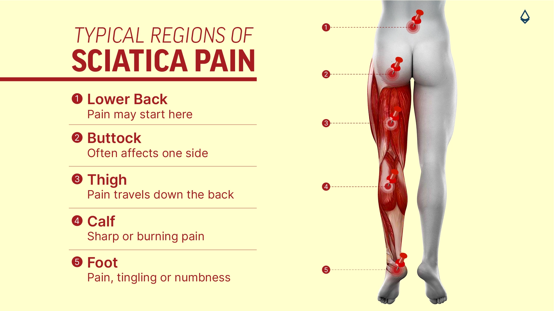 A blog infographic showing the difefrent regions of regions of sciatica pain shown on the lower human body.