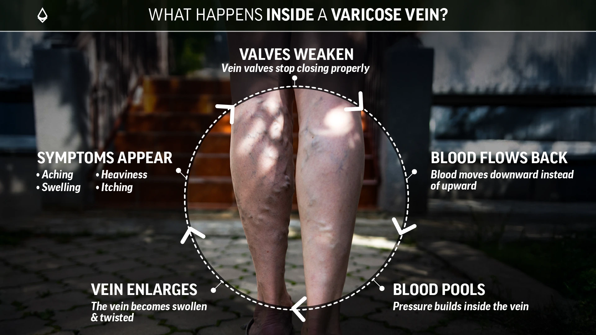 A blog infographic showing how varicose vein develops in a circle around it.